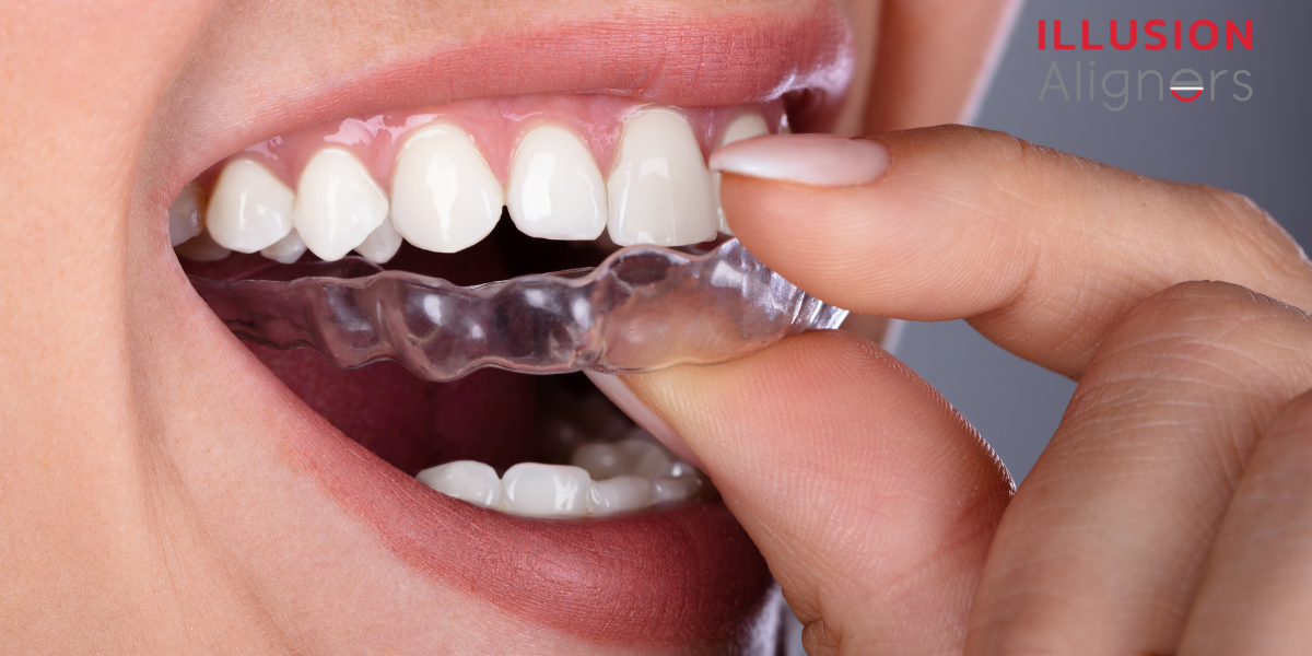 Clear Aligners Your Search For The Best Treatment For Crooked Teeth Ends Here