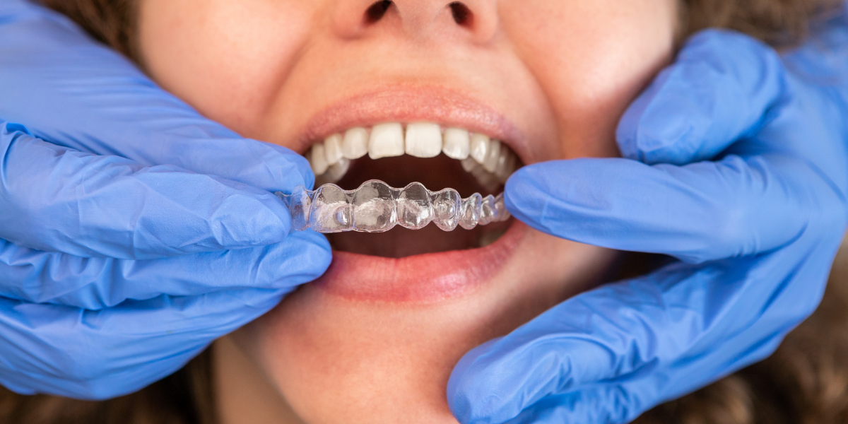 Why aligners and you are a perfect match