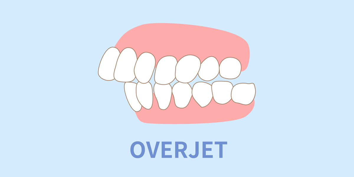 Teeth Overjet